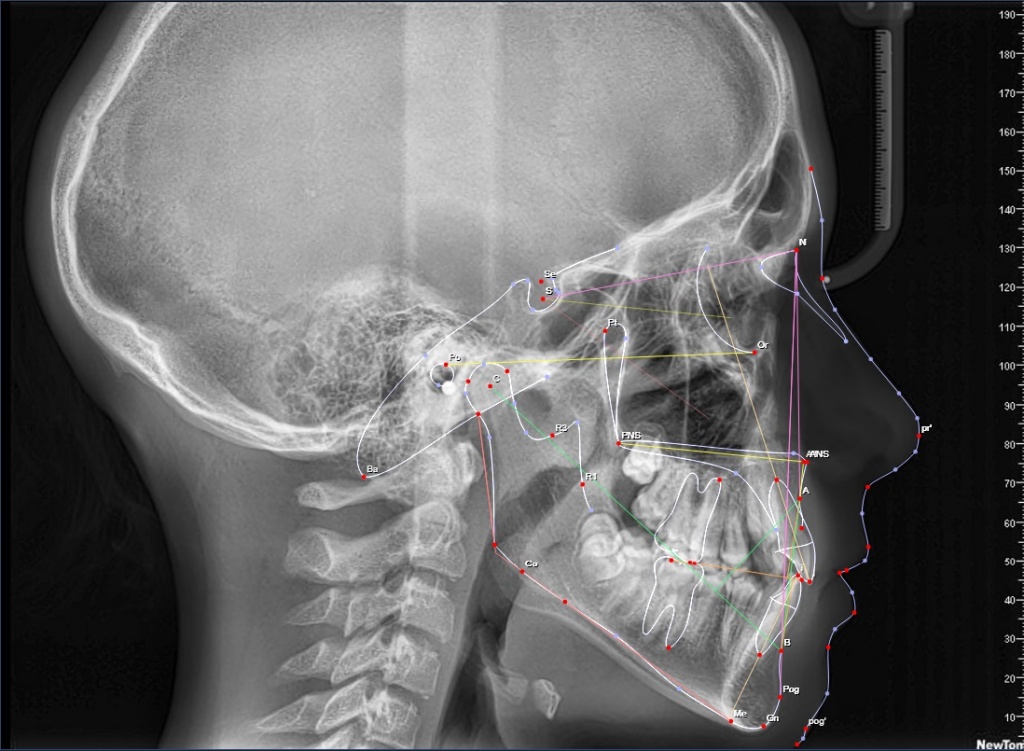 ТРГ – боковой и прямой снимок черепа